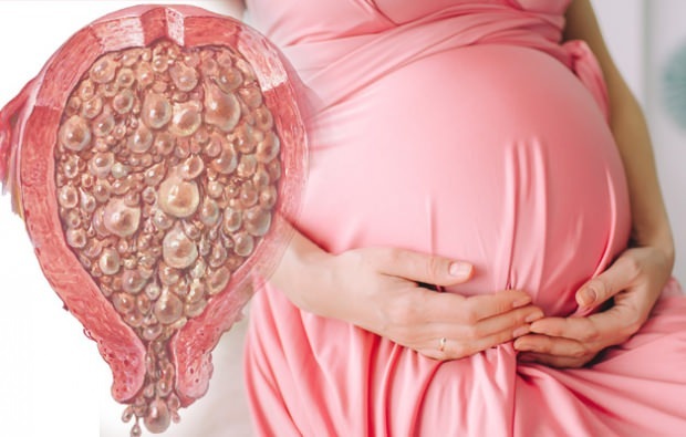 Wat is druivenzwangerschap, druivenzwangerschapssymptomen