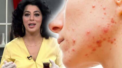 Maskerrecepten om acne te elimineren door Şems Arslan