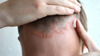 Wat zijn de symptomen van seborrheic dermatitis en voor wie lijkt het? Voedingsmiddelen die de ziekte veroorzaken