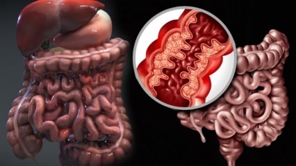 Wat is de ziekte van Crohn? Wat zijn de symptomen van de ziekte van Crohn? Is er een remedie voor Crohn?