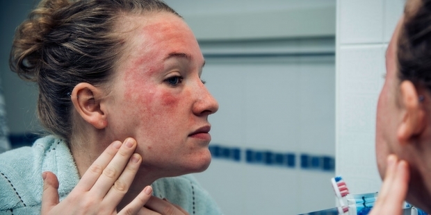 deze verschijnen op de huid van een persoon met een koude allergie