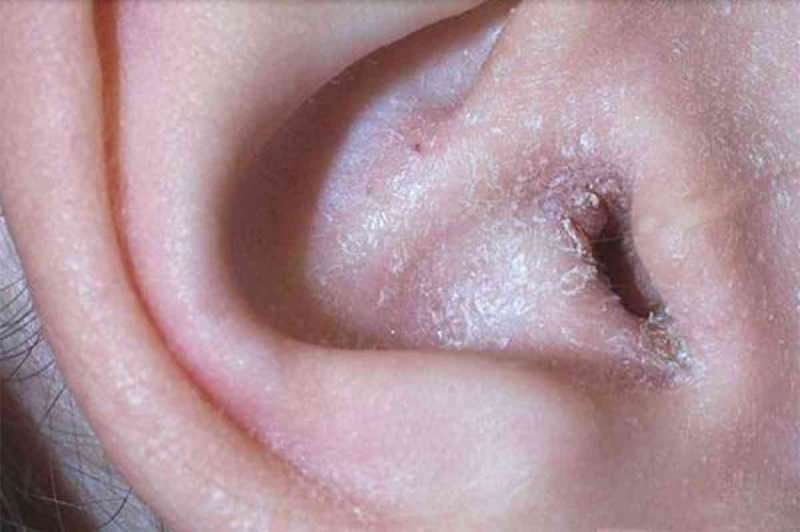 Wat veroorzaakt peeling achter het oor en hoe gaat het voorbij? De definitieve oplossing voor eczeem achter het oor ...