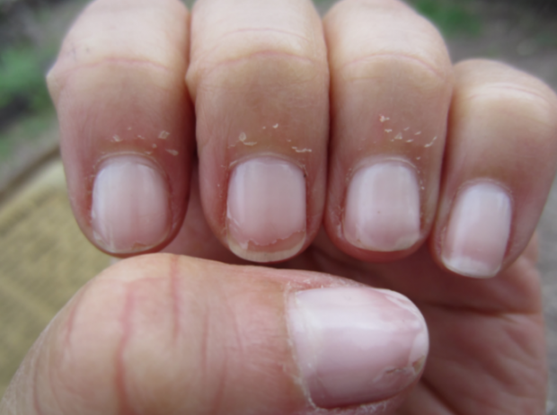 Wat zijn de oorzaken van nagelschillen, hoe wordt het behandeld?