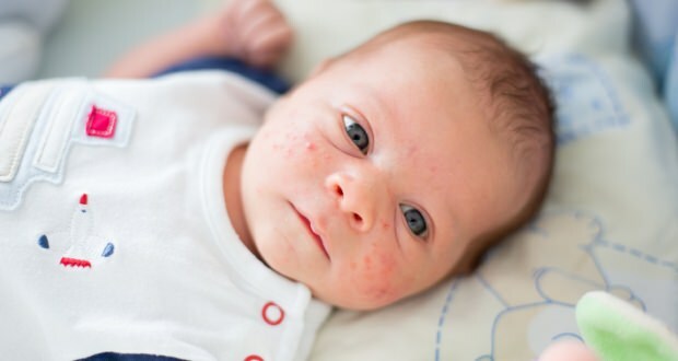 Hoe gaat acne over op het gezicht van de baby? Acne (Milia) droogmethoden