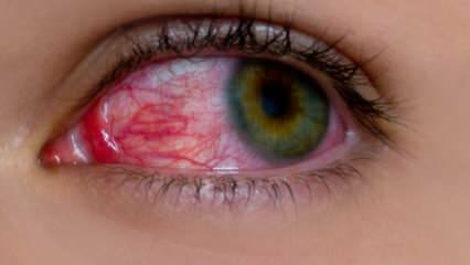 Wat veroorzaakt oogallergie? Wat zijn de symptomen van oogallergie? Wat is goed voor oogallergieën? 
