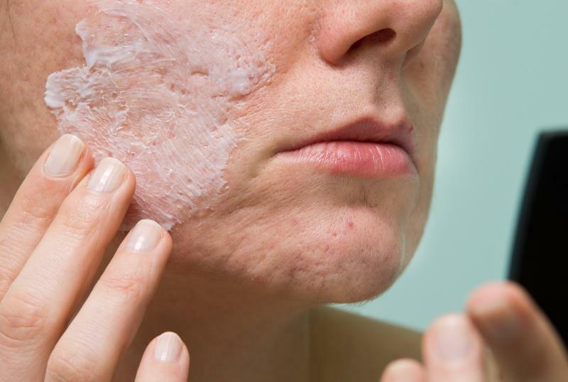 Wat veroorzaakt ontstoken acne en hoe gaat het weg? Masker dat ontstoken acne droogt