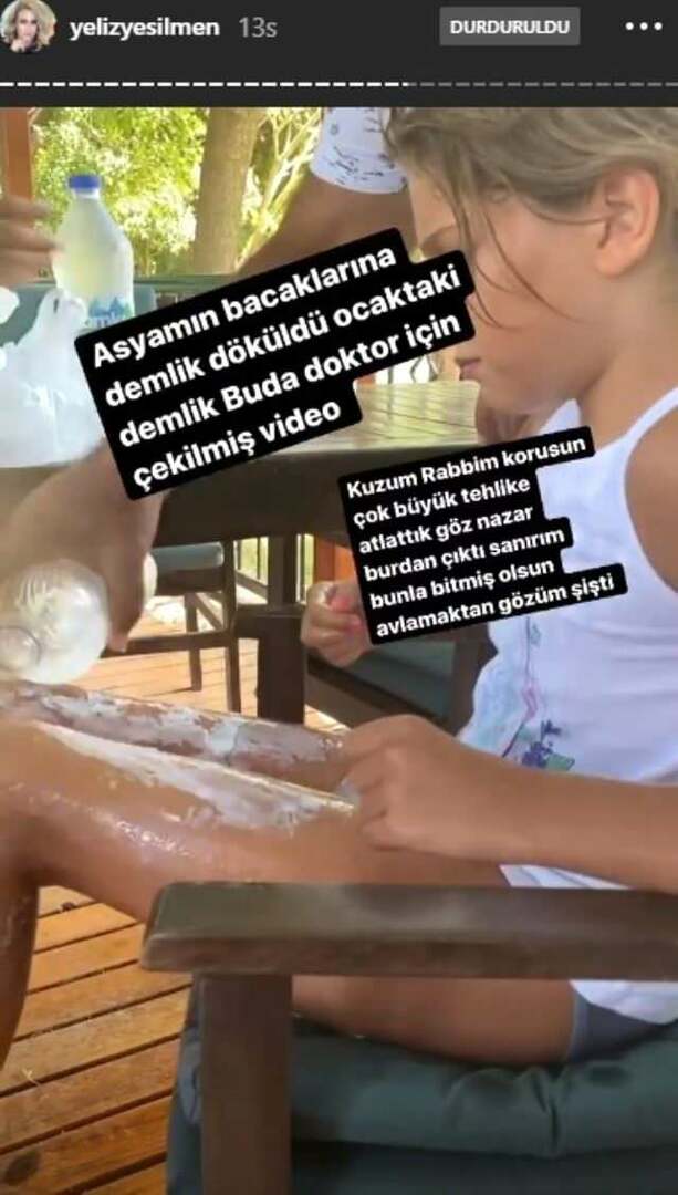 Er werd kokend water op de benen van Yeliz Yesilmen's dochter gegoten