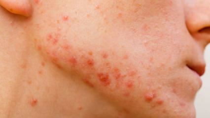 Hoe gaan cystische acne over? Wat is goed voor cystische acne?