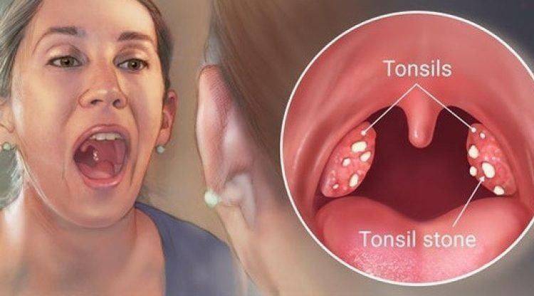 tonsilitis wordt zwelling van de amandelen genoemd