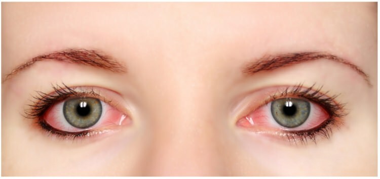 Heeft allergie voor mascara en eyeliner in de ogen?