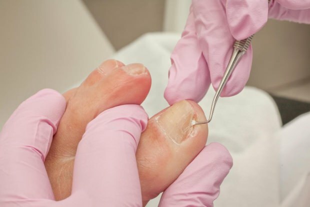 Wat veroorzaakt ingegroeide teennagels en wat zijn de symptomen? Natuurlijke manieren die goed zijn voor ingegroeide nagels ...