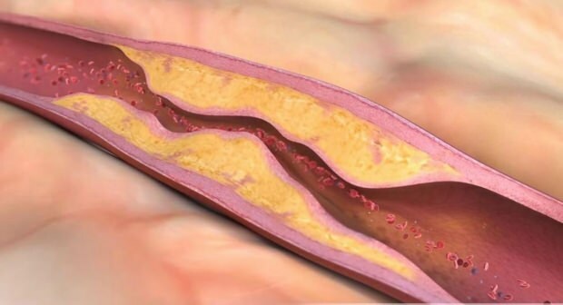 Wat veroorzaakt atherosclerose? Hoeveel soorten vasculaire occlusie zijn er?