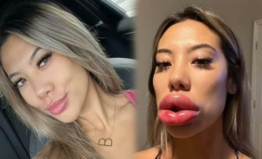 De lippen van de vrouw die fillers had in de VS stonden versteld!
