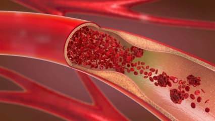 Wat is bloedarmoede (bloedarmoede)? Wat zijn de symptomen van bloedarmoede? Voedingsmiddelen die goed zijn voor bloedarmoede ...