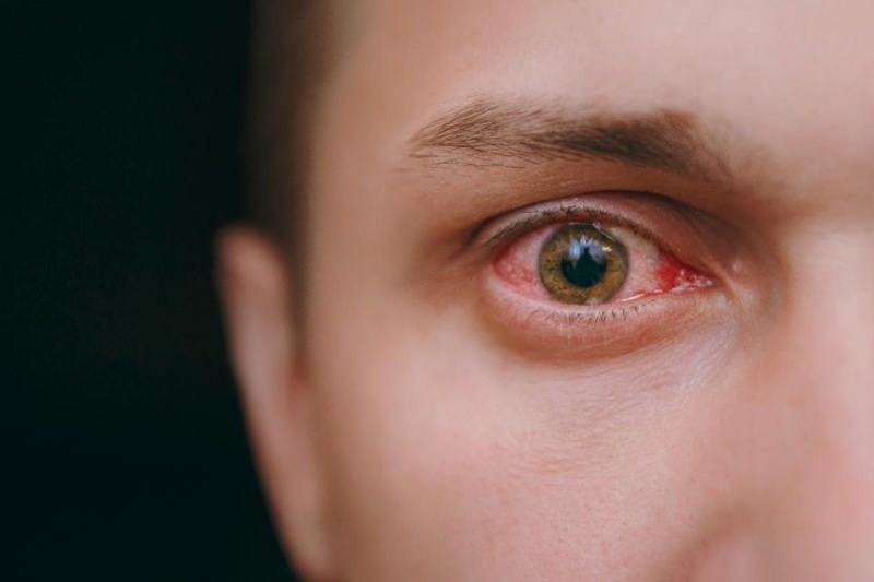 oog watertanden, bloeden en jeukende symptomen van coronavirus