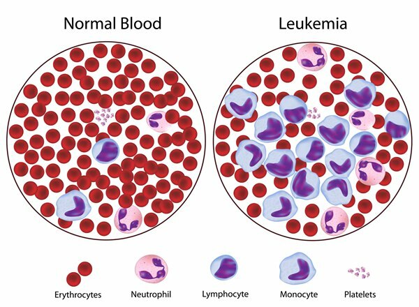 wat is leukemie