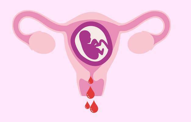 oorzaken van bloeding tijdens de zwangerschap