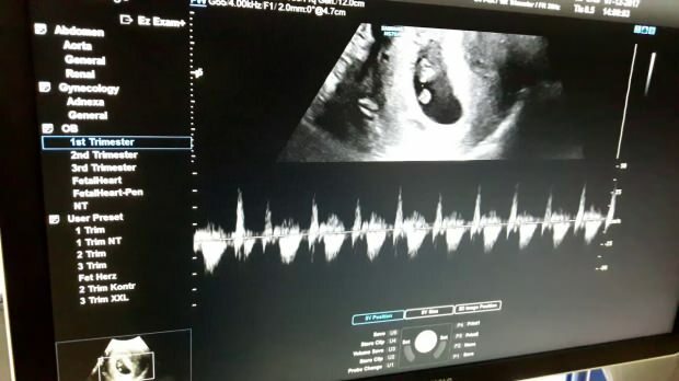 Wanneer is de hartslag van de baby in de baarmoeder te horen? Als de hartslag van de baby niet wordt gehoord ...