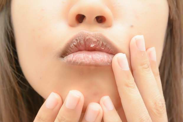bloedarmoede veroorzaakt droge lippen