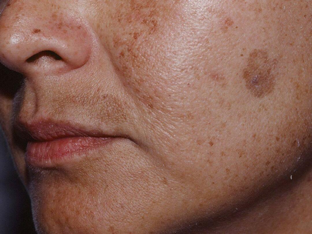 Wat is het Vlekprotocol en hoe wordt het uitgevoerd? Is Blemish Protocol schadelijk voor de huid?