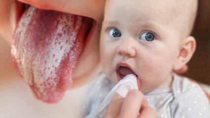 Symptomen en behandeling van spruw bij baby's! Hoe is spruw bij baby's?