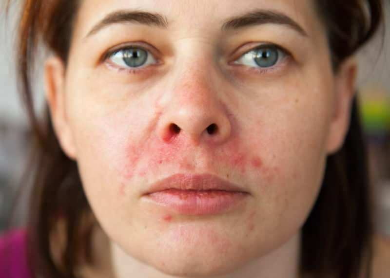 Waarom verschijnt acne rond de lip? Hoe wordt periorale dermatitis behandeld?