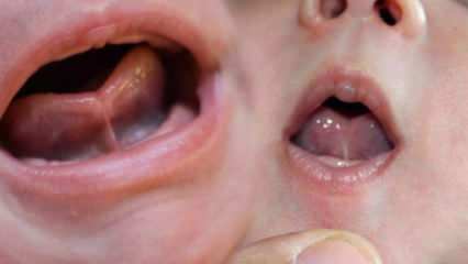 Wat is de tongband (Ankyloglossi) bij zuigelingen? Symptomen en behandeling van tongbindingen ...