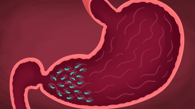 sommige virussen en bacteriën kunnen gastritis veroorzaken