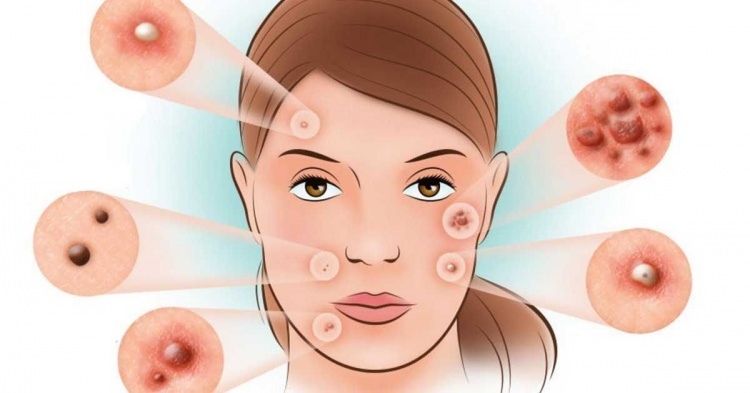 Hoe wordt acne behandeld?