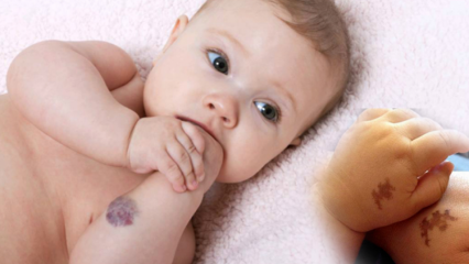 Veroorzaakt moedervlek bij baby's, is het permanent? Wat zijn de soorten moedervlekken? Behandeling van Saracoglu