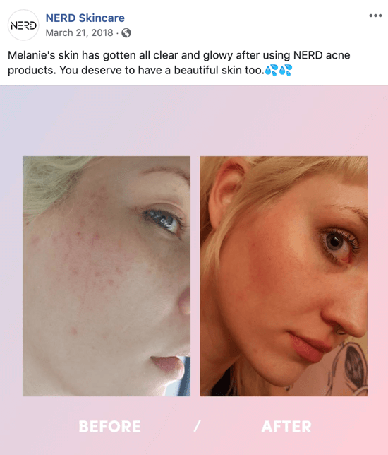 Voorbeeld van hoe Nerd Skincare een voor-en-na-foto gebruikte om een ​​afbeeldingspost voor sociale media te maken die de aankoop van hun producten stimuleert.