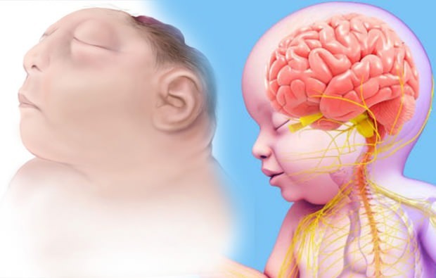 Leeft Anencephaly baby? Anencefalie-diagnose