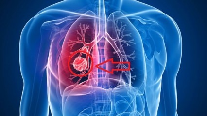 Symptomen van longkanker: stadia van longkanker!