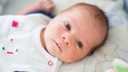 Hoe gaan puistjes op het gezicht van de baby? Droogmethoden voor acne (Milia)