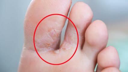 Wat is voetschimmel? Wat zijn de symptomen van voetschimmel? Behandeling van voetschimmel 