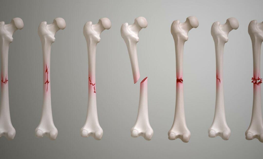 Wat is het sleutelbeen? Hoe lang duurt het voordat een sleutelbeenbreuk geneest?