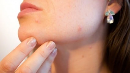 Natuurlijke remedie tegen acne op de kin