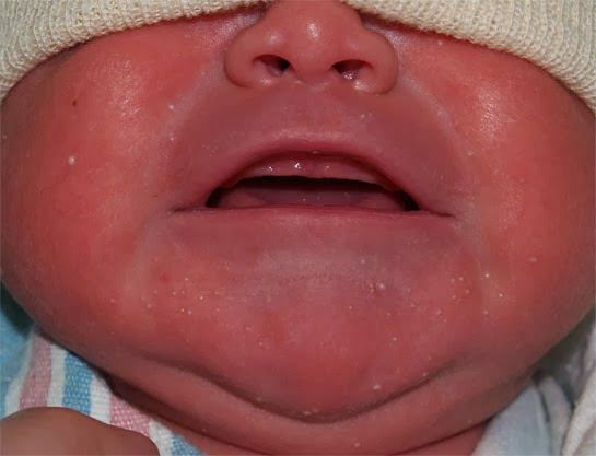 Waarom verschijnen er witte stippen bij baby's?