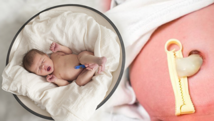 Wat is Placenta Previa? Hoe navelstrengverzorging bij baby's doen? Als de navelstreng lang is ...
