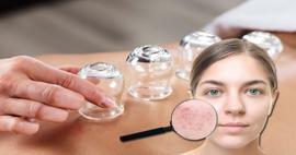 Wat zijn de voordelen van cupping voor huid en haar? Kan cupping acne genezen?