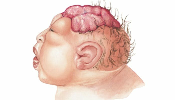 Wat is Anencephaly? Wat zijn de symptomen van Anencephaly bij zuigelingen en kinderen? Anencefalie veroorzaakt ...