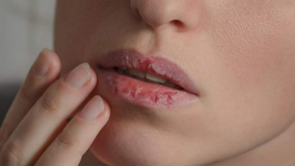 Hoe zorg je voor de lippen thuis? Gemakkelijke verzorging van droge lippen in 4 stappen