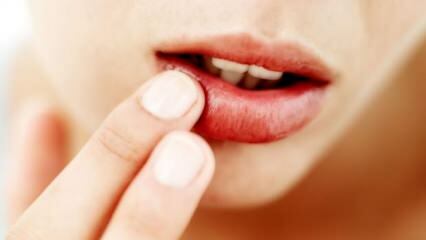 Wat is goed voor het kraken van lippen?