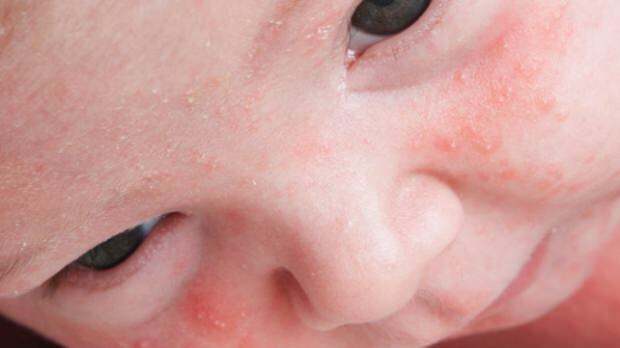 Hoe gaat acne over bij zuigelingen?