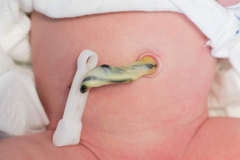 Wanneer wordt de navelstreng doorgesneden bij baby's? Voordelen van het laat doorsnijden van de navelstreng