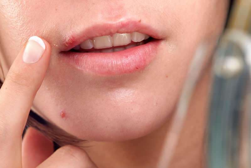 herpes komt meestal uit op de rand van de lip.