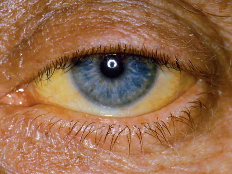 hoogte op bilirubine-niveau veroorzaakt gele kleur op de ogen en huid