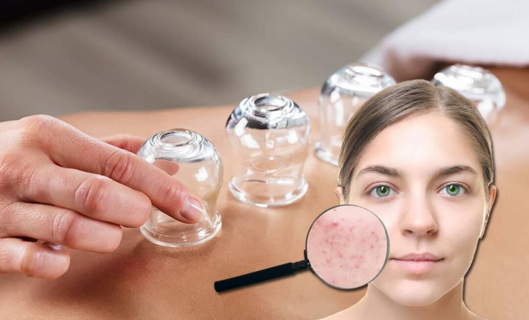 Wat zijn de voordelen van cupping voor huid en haar? Kan cupping acne genezen?