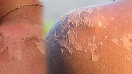 Wat is goed voor peeling van de huid en hoe pelt de huid? Home remedie voor peeling van de huid