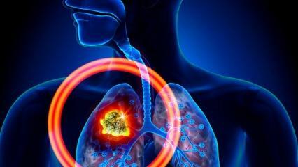 Wat zijn de symptomen van longkanker? Is er een behandeling voor longkanker?